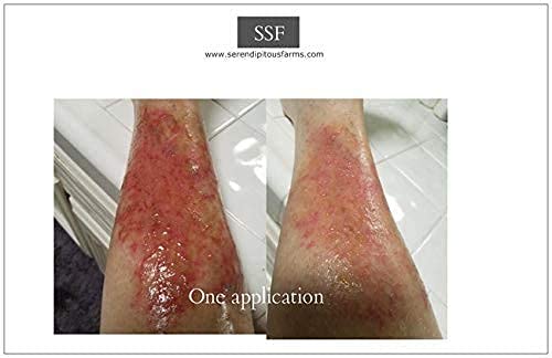 The Hairy Gnome Drawing Salve Ointment, This Stuff Sucks! Poison Out. Handmade with Organic Ingredients. Old Timey Plantain and Pine Sap Recipe for Infections, Poison Ivy, and Boils.